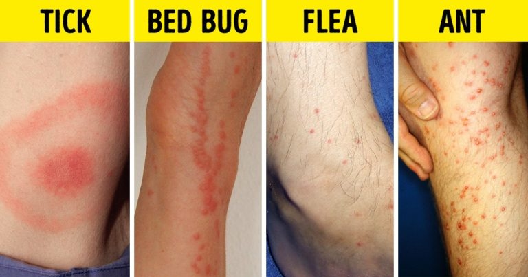 bug-bite-chart-insect-bite-treatment-insect-bites-insect-bite-remedy