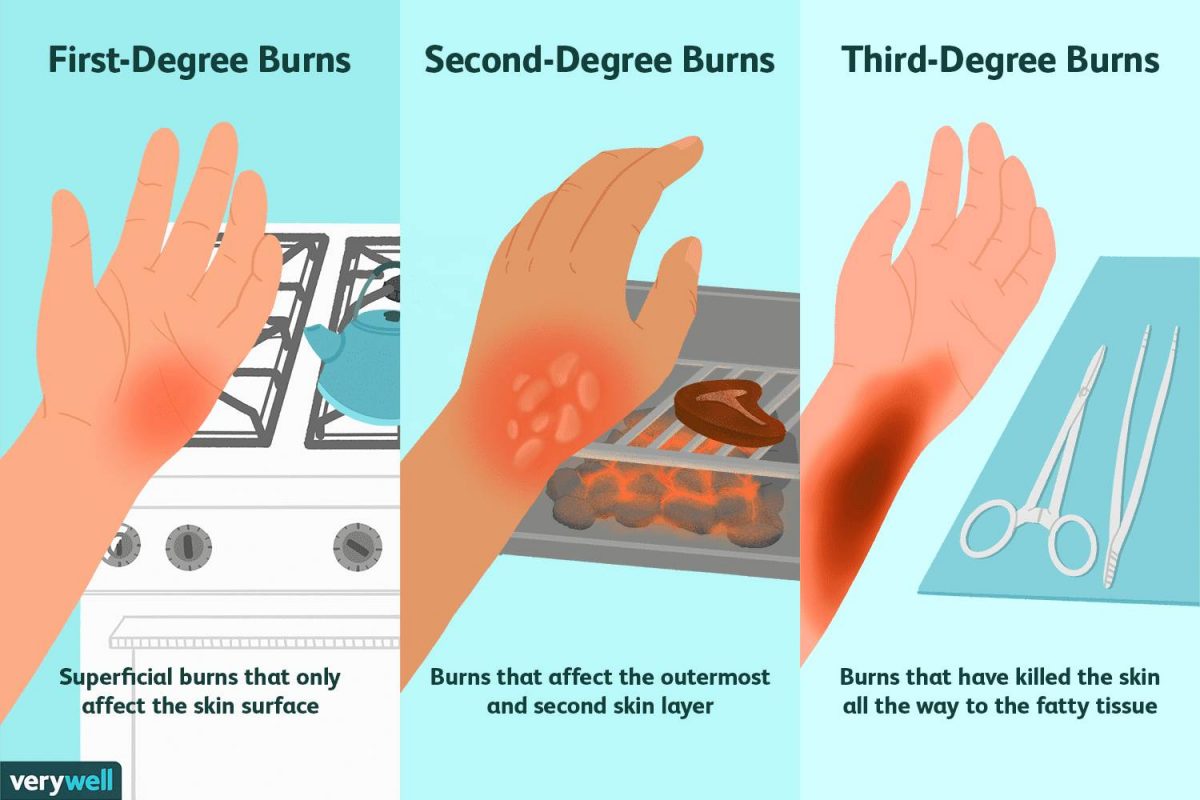 Frist Aid for Burns | Dr JoAnn Child Specialist