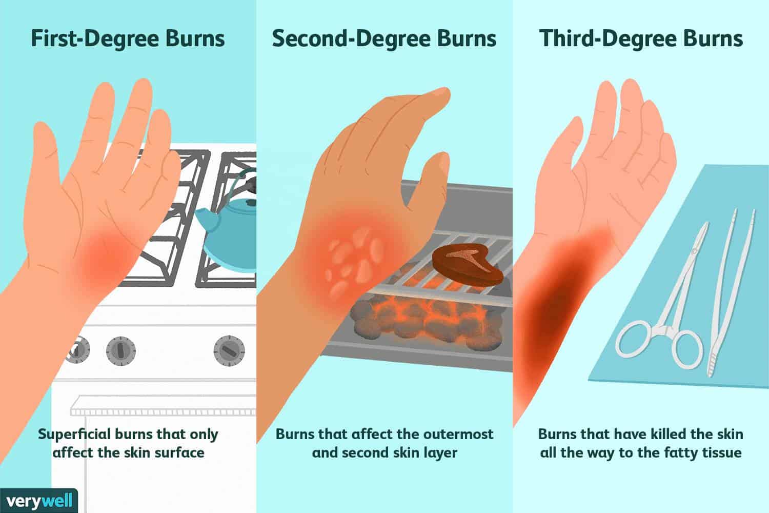 2nd degree burn healing stages