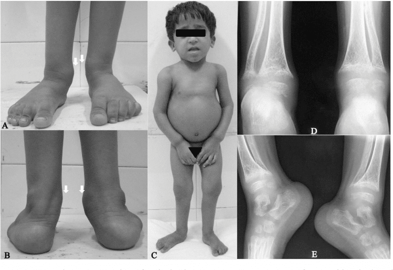 vitamin-d-deficiency-in-children-dr-joann-child-specialist