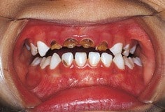 tooth decay due to vitamin D deficiency