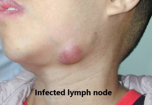 sore lymph node on back of head