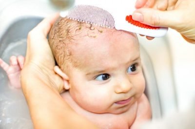 cradle cap treatment