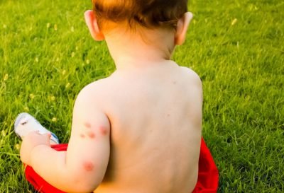 newborn bitten by mosquito